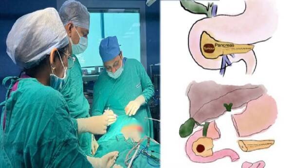 AIIMS ने दुर्लभ कीहोल सर्जरी कर 11 साल की लड़की की बचाई जान, बनी विश्व की सबसे छोटी मरीज